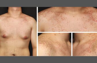 Man’s Change to Keto Food regimen Triggers Weird, Uncommon Rash