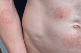 A STI Fungus Is Making Itself Cozy within the US